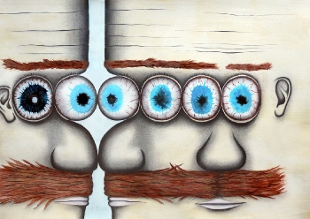 No. 14. Conjoined Triplets Joined at the Eyes